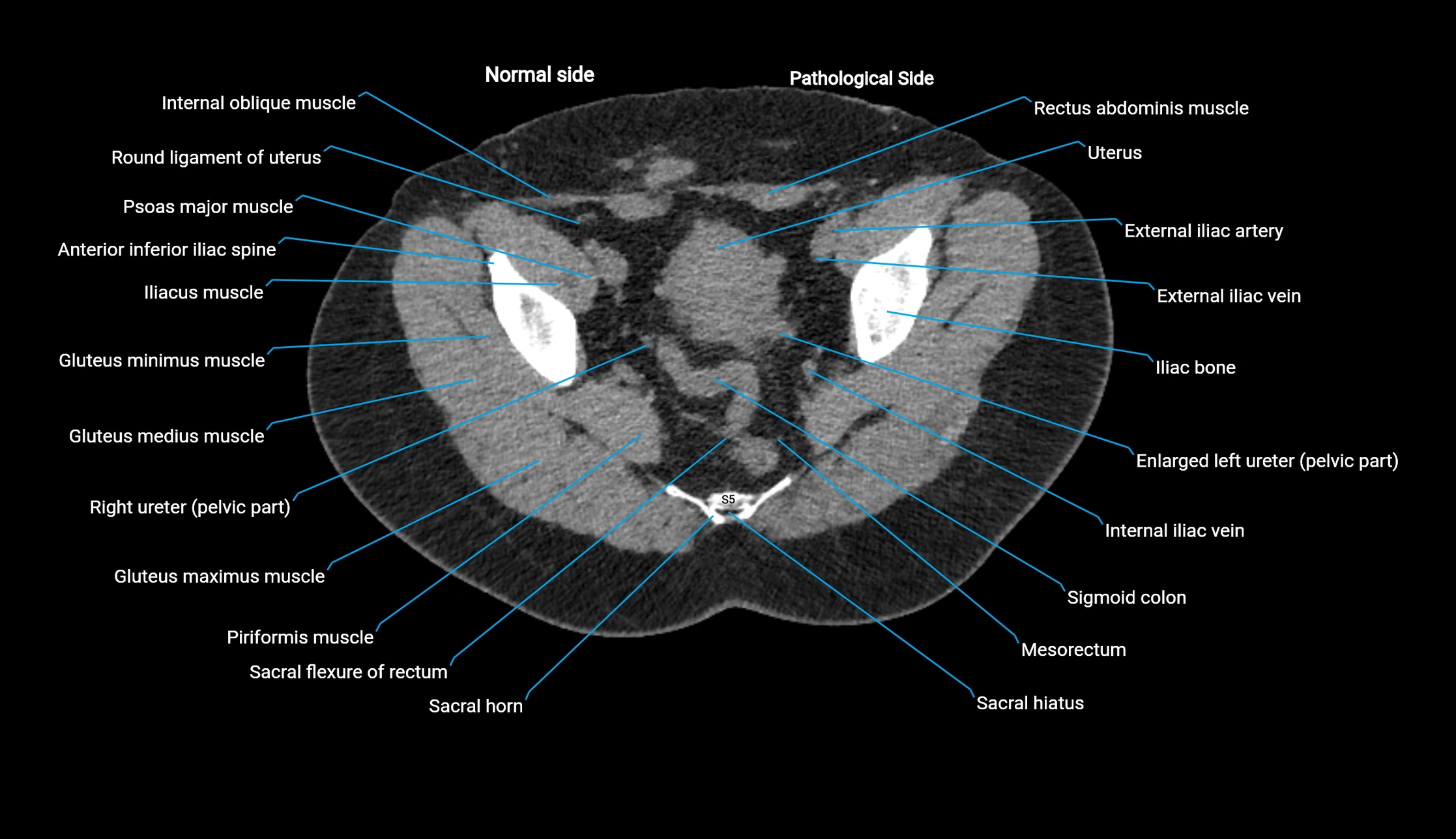 CT KUB axial cross sectional anatomy  radiology image -img-00201-00144.webp